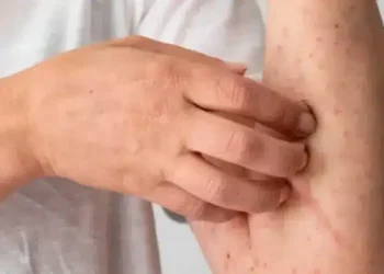 Como saber se tenho alergia ao camarão