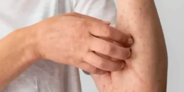 Como saber se tenho alergia ao camarão