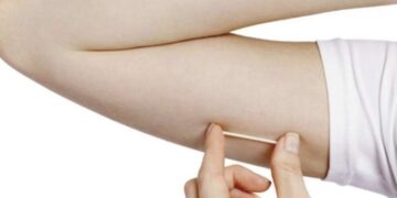 Entenda como funciona o Implanon, novo contraceptivo oferecido pelo SUS
