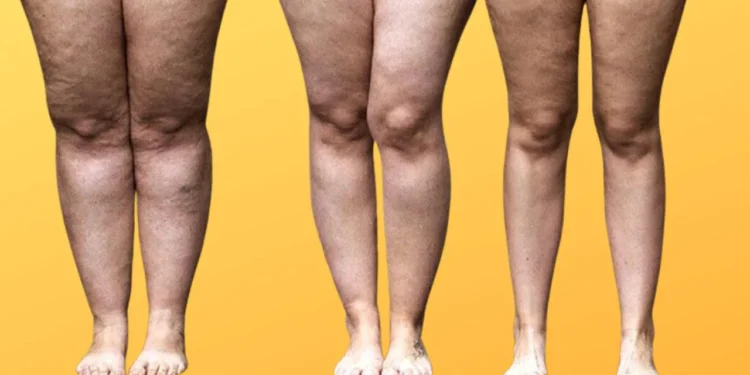 O que é lipedema e como cuidar