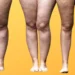 O que é lipedema e como cuidar