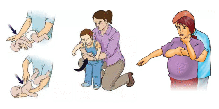 Veja passo a passo para realizar a manobra de Heimlich em você mesmo